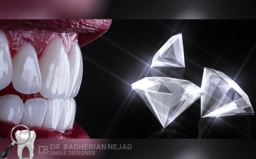 لمینت ایمکس در اصفهان