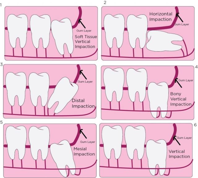 انواع دندان عقل