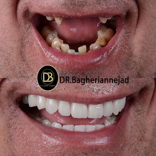 ایمپلنت اقساطی در بهارستان