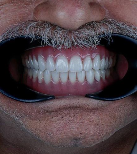 دندان مصنوعی در اصفهان