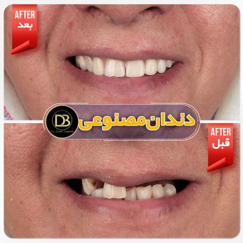دندان مصنوعی با ایمپلنت در اصفهان
