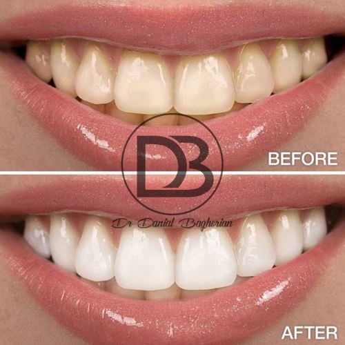 بهترین دکتر بلیچینگ در اصفهان