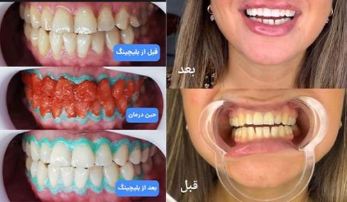 بهترین دکتر بلیچینگ در اصفهان