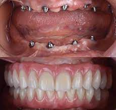 ایمپلنت اقساطی در خمینی شهر