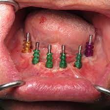 ایمپلنت دندان در باغ بهادران