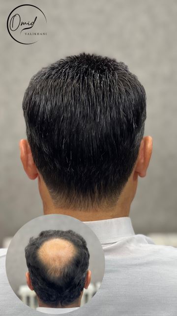 پروتز مو اصفهان