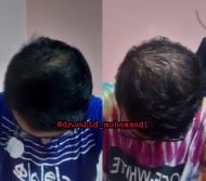 کاشت مو در دزفول