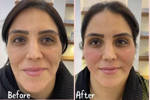 تزریق چربی-بهترین دکتر زیبایی در دزفول