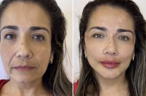 تزریق چربی-دکتر زیبایی در دزفول