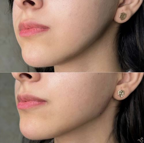 فیلر چونه-بهترين دکتر زیبایی در دزفول