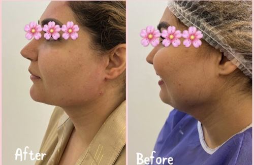 تخلیه غبغب-دکتر زیبایی در دزفول