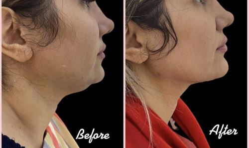 زاویه صورت-بهترین دکتر زیبایی در دزفول