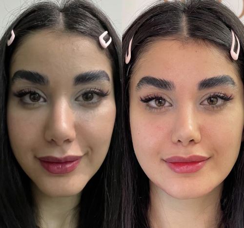 تزریق چربی_دکتر زیبایی دزفول دزفول