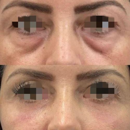 بلفاروپلاستی پلک پایین- دکتر زیبایی در دزفول