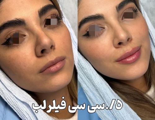 فیلر لب- دکتر زیبایی در دزفول