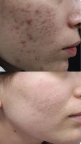 لیزر co2 فرکشنال-بهترین دکتر زیبایی در دزفول