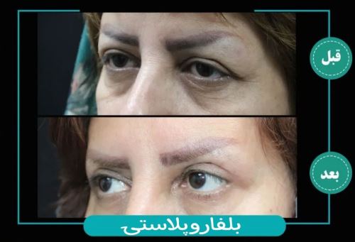 بلفاروپلاستی-دکتر زیبایی در دزفول
