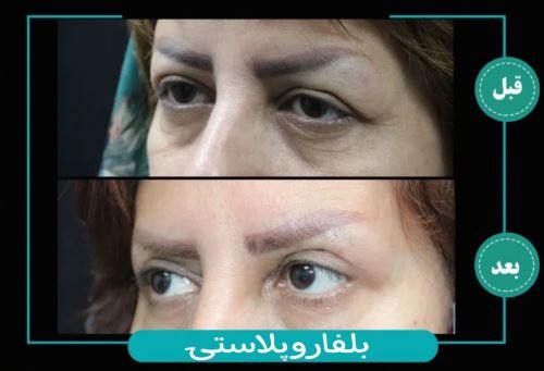 رفع جا جوش با پکیج ترکیبی-دکتر زیبایی در دزفول