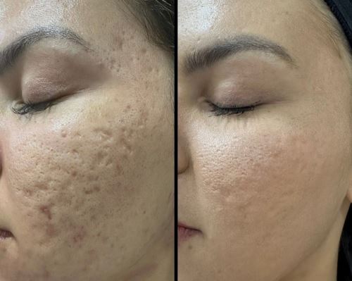 رفع جا جوش با پکیج ترکیبی-بهترین دکتر زیبایی دزفول