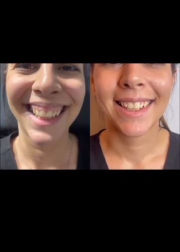 بوتاکس لبخند لثه ای_ دکتر زیبایی در دزفول