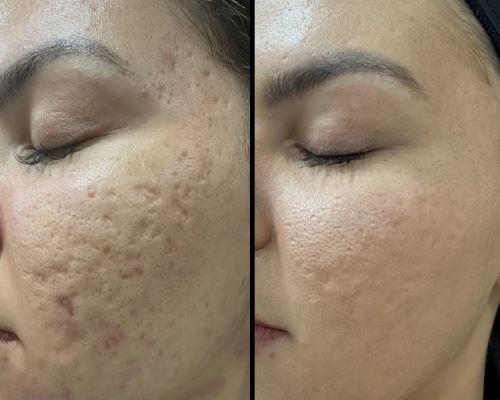 رفع جا جوش با لیزرco2فرکشنال_دکتر زیبایی در دزفول