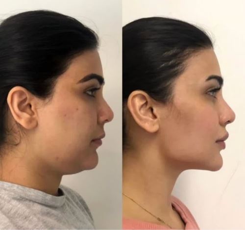 زاویه سازی فک و ساکشن غبغب،لیزر زیبایی دزفول