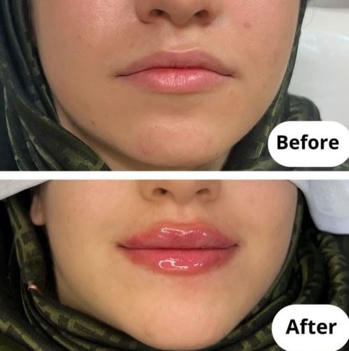 فیلر لب،لیزر زیبایی دزفول