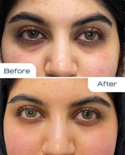 فیلر زیر چشم،لیزر زیبایی دزفول