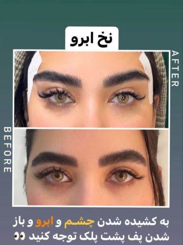 لیفت ابرو با نخ،لیزر زیبایی دزفول