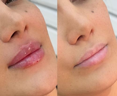 فیلر نچرال لب،لیزر زیبایی دزفول