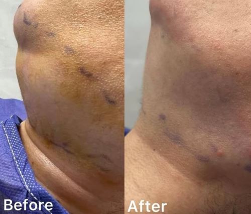 ساکشن غبغب،لیزر زیبایی دزفول