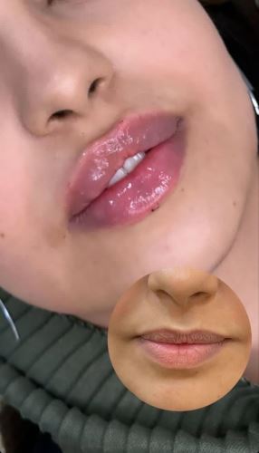 فیلر لب،لیزر زیبایی دزفول