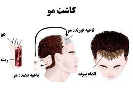 متخصص کاشت مو در شیراز