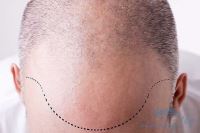 متخصص کاشت مو در شیراز