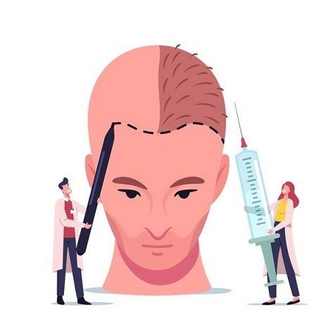 متخصص کاشت مو در شیراز