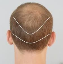 متخصص کاشت مو در شیراز