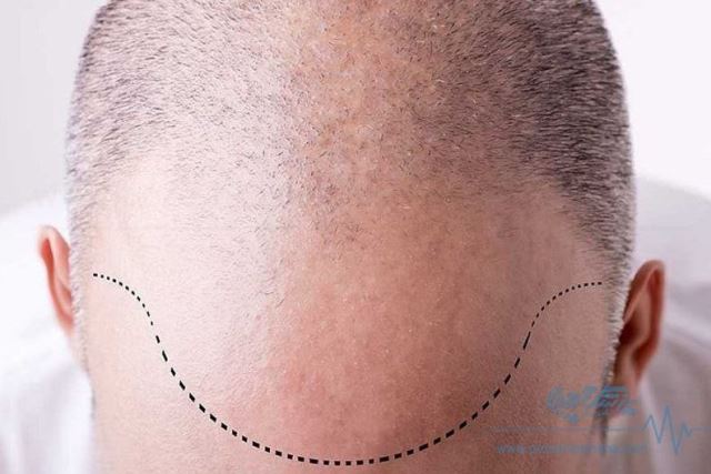 متخصص کاشت مو در شیراز