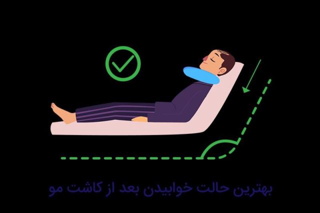 متخصص کاشت مو در شیراز