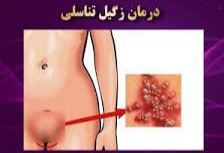 درمان قطعی زگیل تناسلی خرم اباد