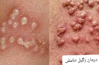 درمان قطعی زگیل تناسلی خرم اباد