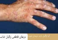 درمان قطعی زگیل تناسلی خرم اباد