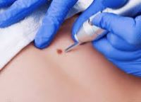 درمان قطعی زگیل تناسلی خرم اباد