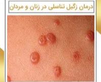 درمان قطعی زگیل تناسلی خرم اباد