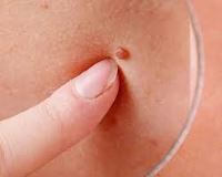 درمان قطعی زگیل تناسلی خرم اباد