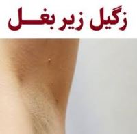 درمان قطعی زگیل تناسلی خرم اباد