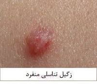 درمان قطعی زگیل تناسلی خرم اباد