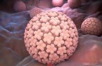 درمان قطعی زگیل تناسلی خرم اباد