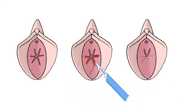 دوختن پرده بکارت در خرم اباد