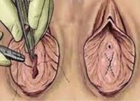 دوختن پرده بکارت در خرم اباد