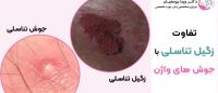 درمان قطعی زگیل تناسلی خرم اباد